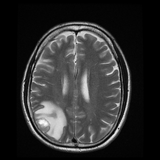 Brain Tumor Mri Results