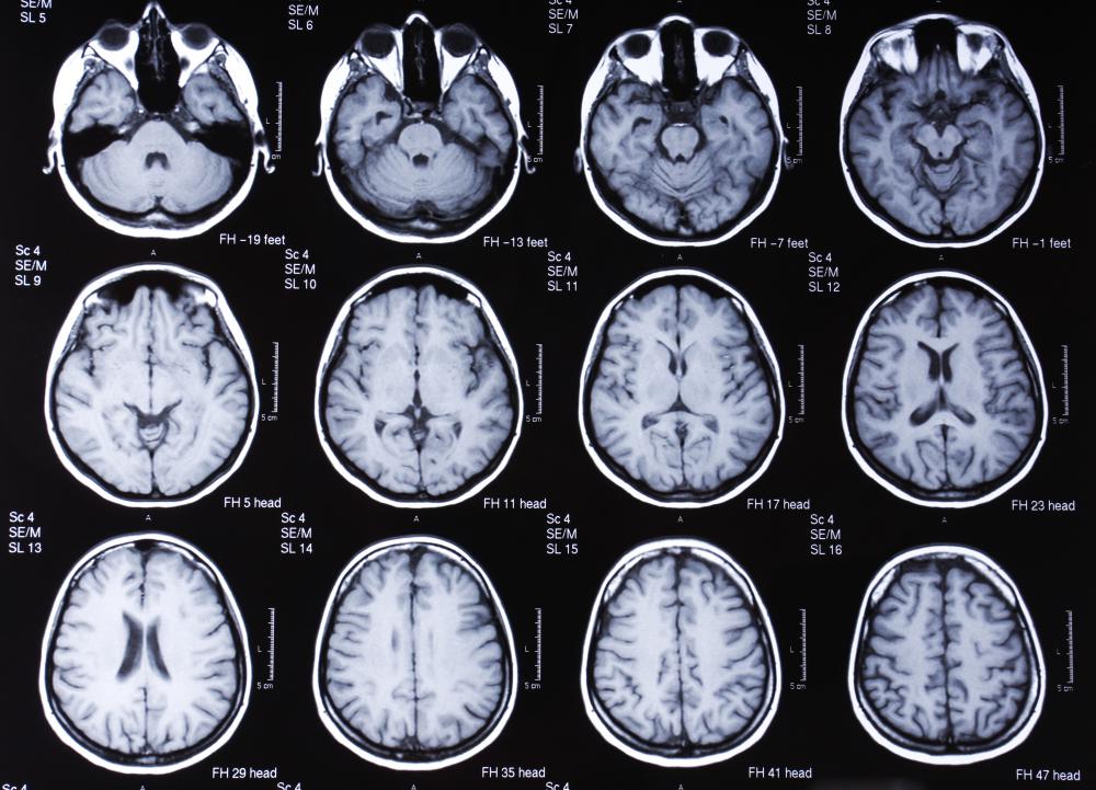 Brain Tumor Mri Results