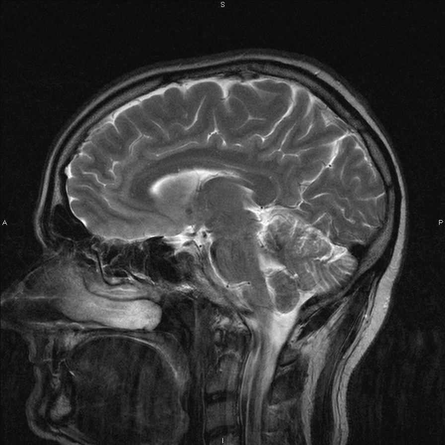 Brain Tumor Mri Scan