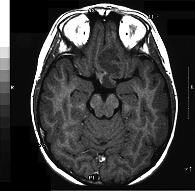 Brain Tumor Mri Scan