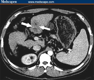 Brain Tumor Mri Vs Ct