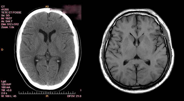 Brain Tumor Mri Vs Ct