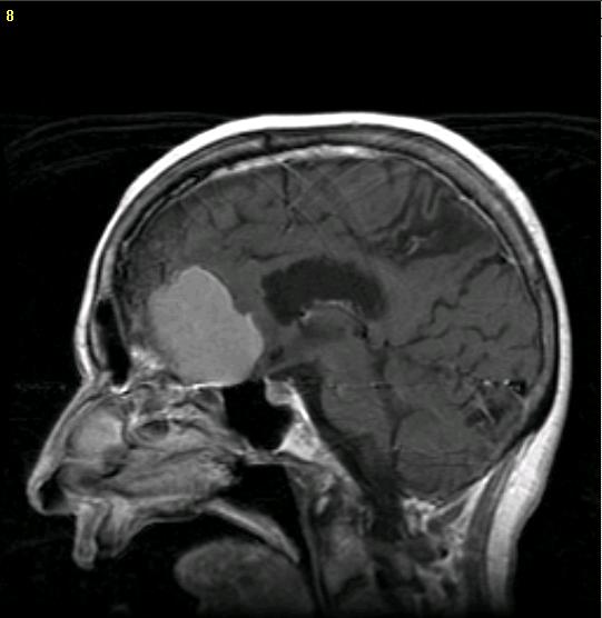 Brain Tumor Pictures Mri