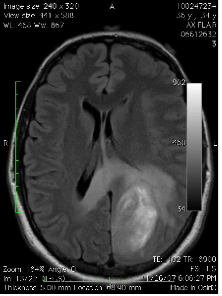 Brain Tumor Pictures Mri