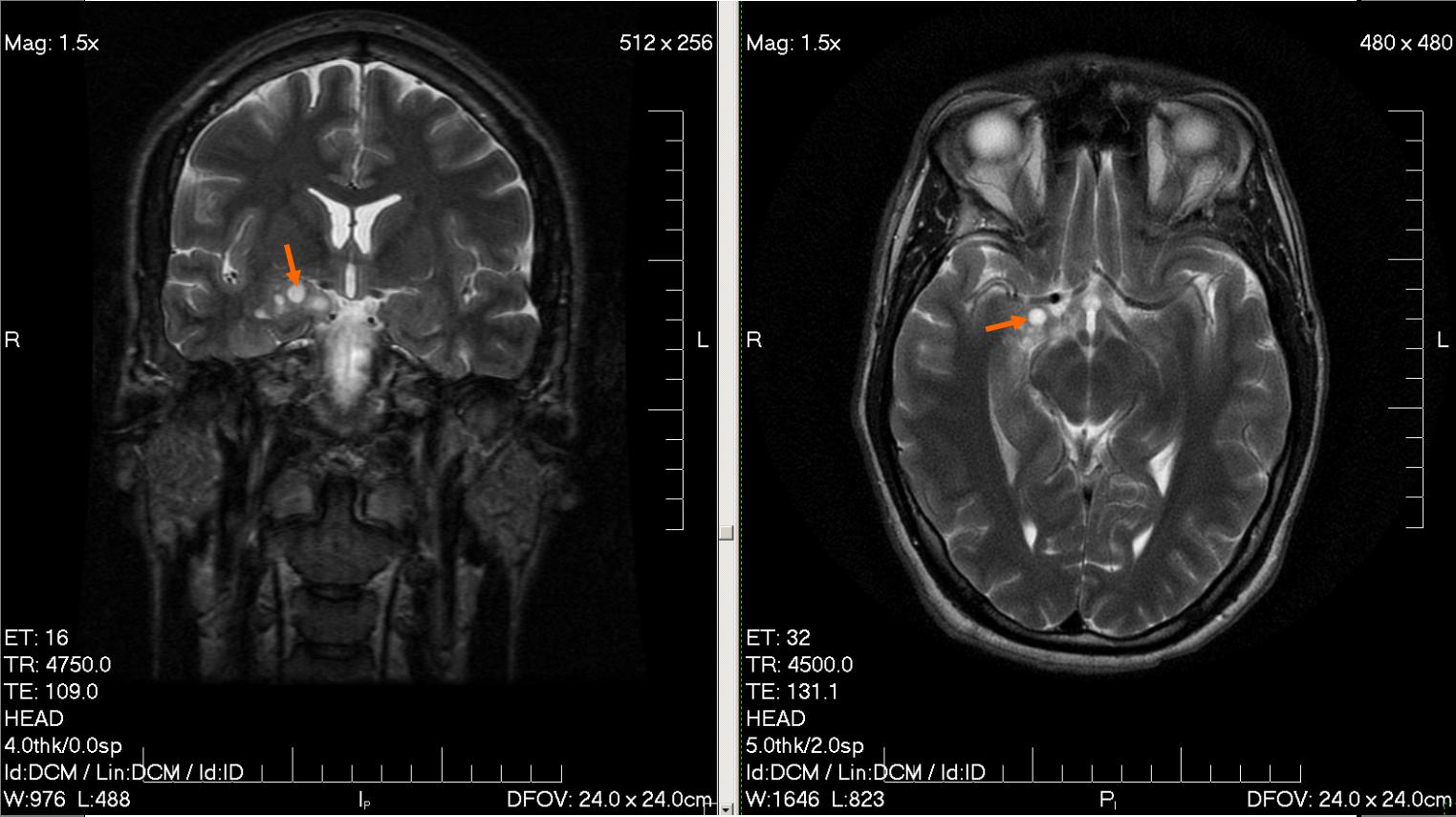 Brain Tumor Pictures Mri