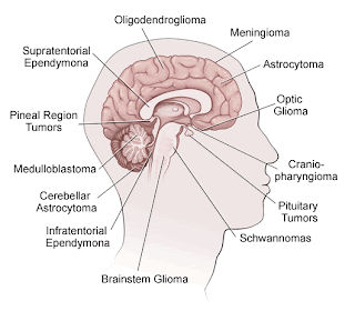 Brain Tumor Pictures Photos