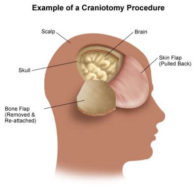 Brain Tumor Surgery Procedure