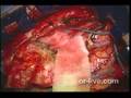 Brain Tumor Surgery Video