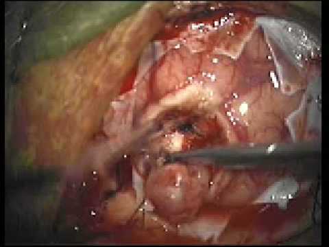 Brain Tumor Surgery Video