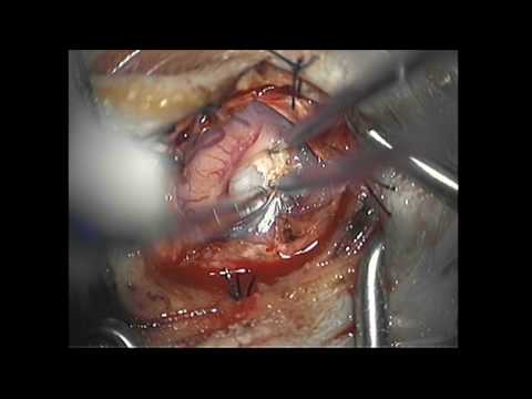 Brain Tumor Surgery Video