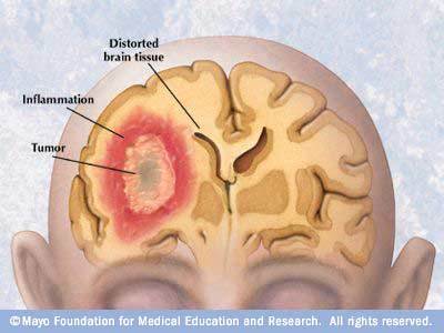 Brain Tumor Symptoms In Kids