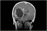 Brain Tumor Symptoms In Kids