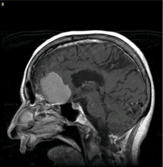 Brain Tumor Symptoms In Kids