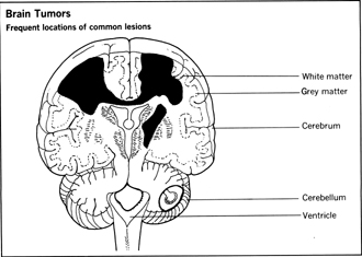 Brain Tumor Symptoms In Men