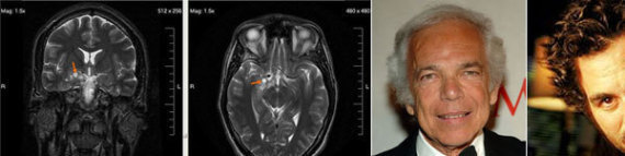 Brain Tumor Symptoms In Men