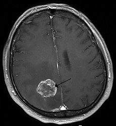 Brain Tumor Symptoms In Men