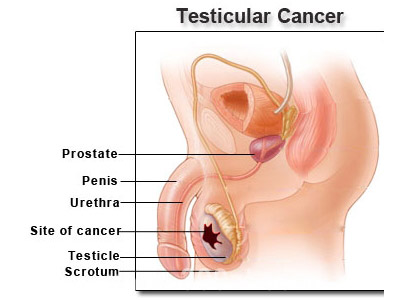 Brain Tumor Symptoms In Men