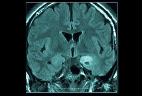 Brain Tumor Symptoms Webmd