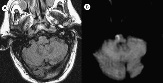 Brainstem Anatomy Mri