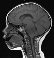 Brainstem Anatomy Mri