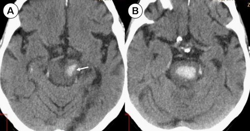 Brainstem Anatomy Mri