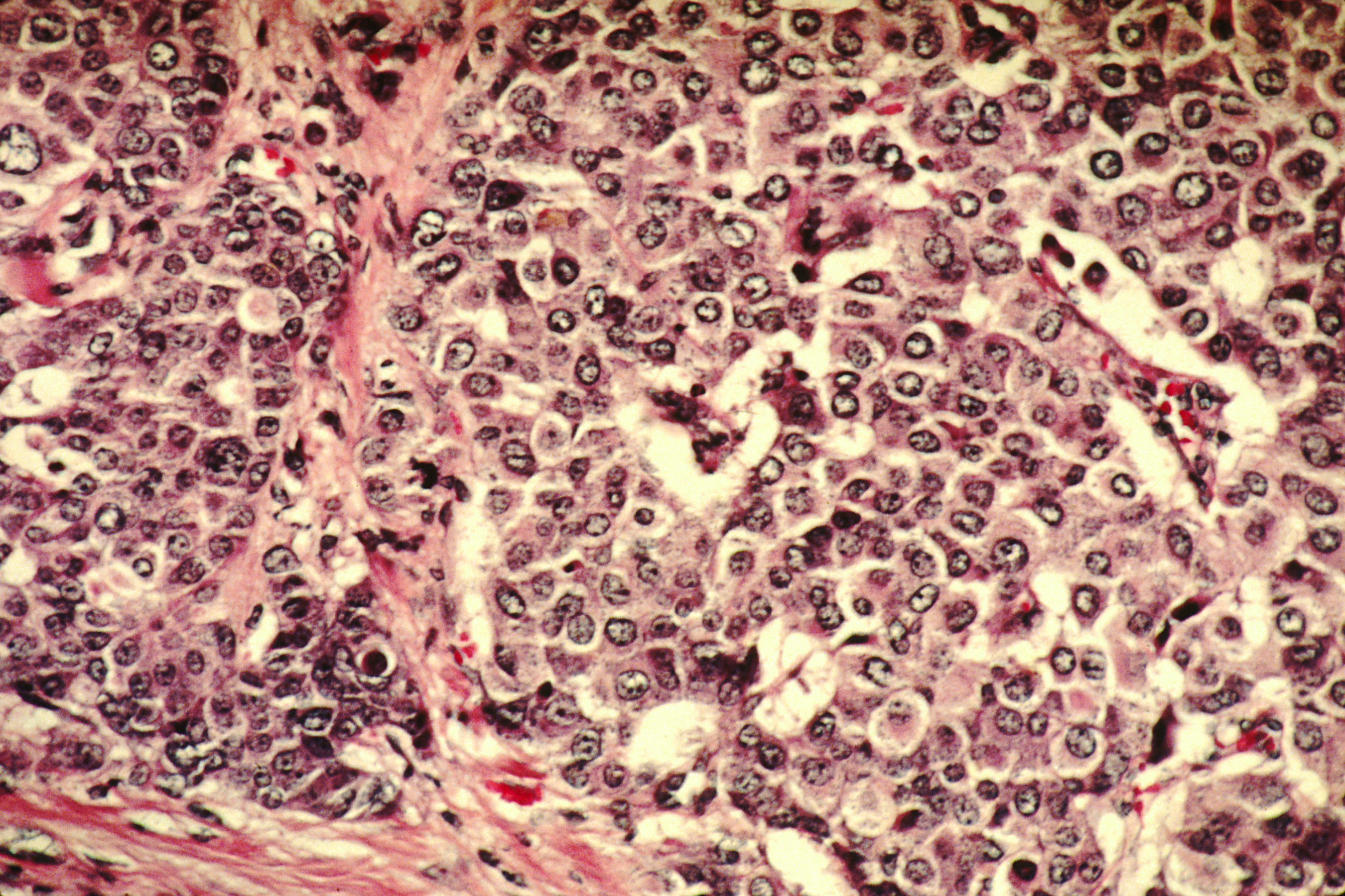 Breast Cancer Cells Size