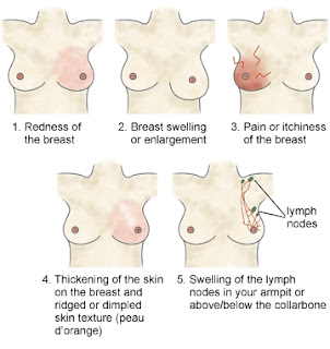 Breast Cancer Lump Images