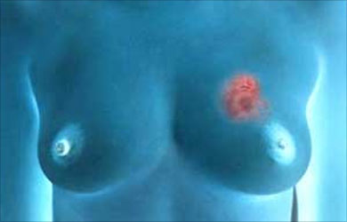 Breast Cancer Lump Images