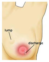 Breast Cancer Lump Look Like