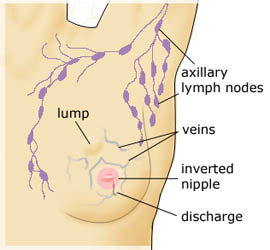 Breast Cancer Lump Look Like