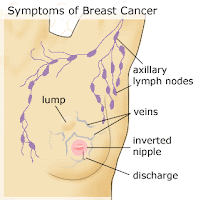 Breast Cancer Lump Pictures