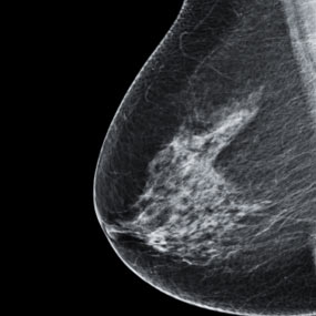 Breast Cancer Lump Symptoms