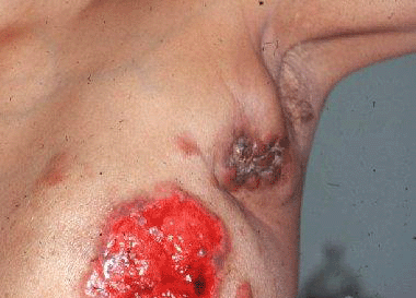 Breast Cancer Pictures Images