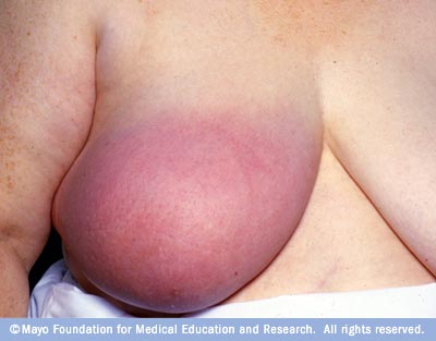 Breast Cancer Pictures In Men