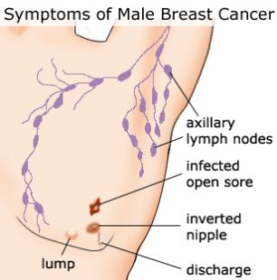 Breast Cancer Pictures In Men