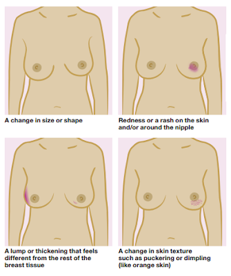 Breast Cancer Symptoms Images