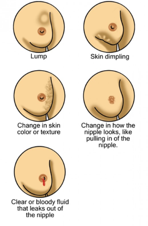 Breast Cancer Symptoms Lump