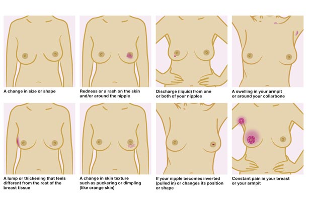 Breast Cancer Symptoms Lump