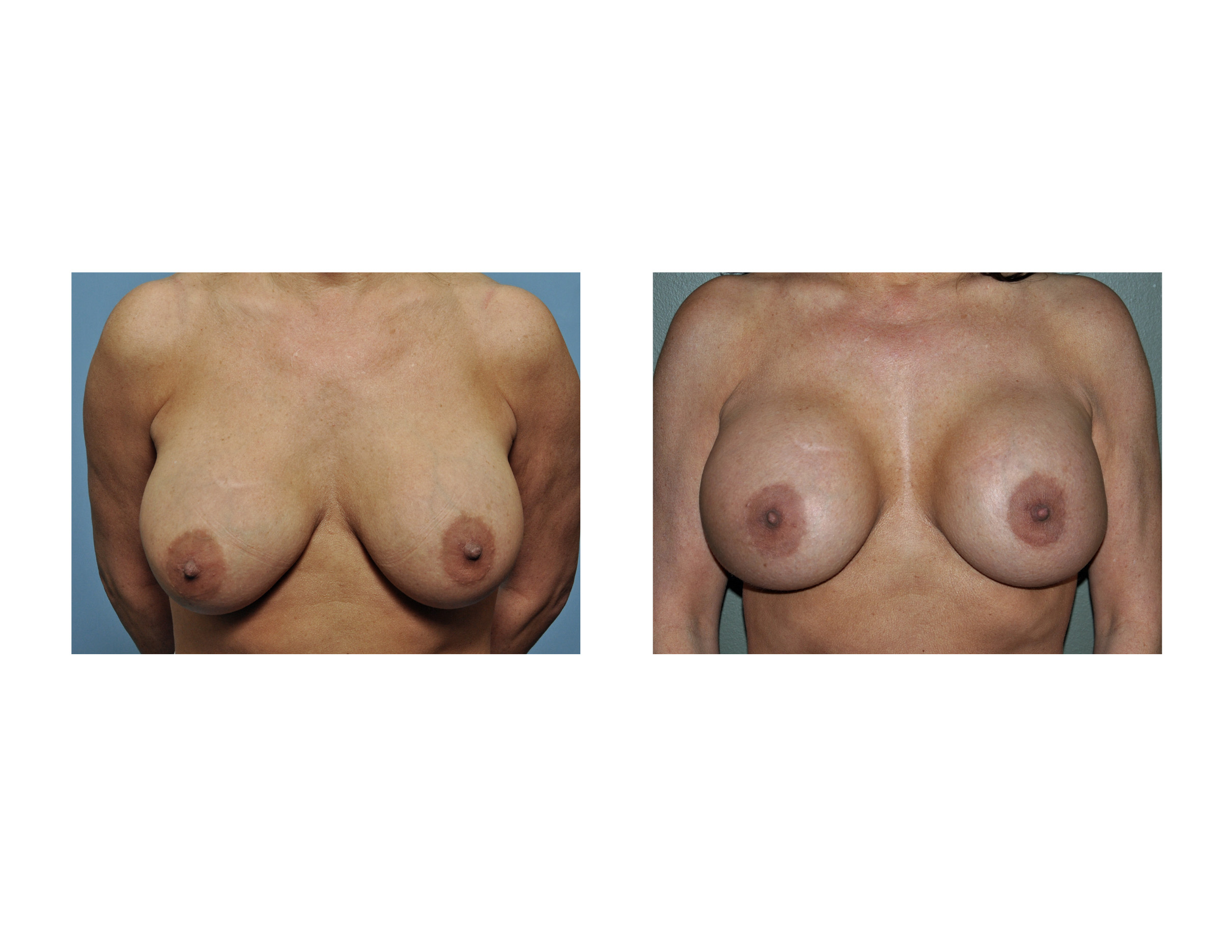 Breast Implants Pictures