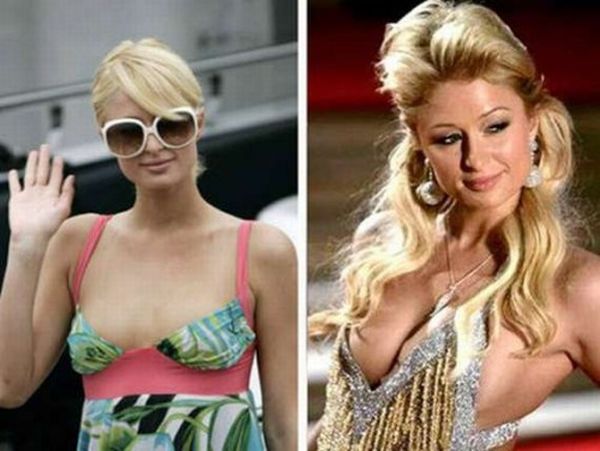 Breast Implants Pictures