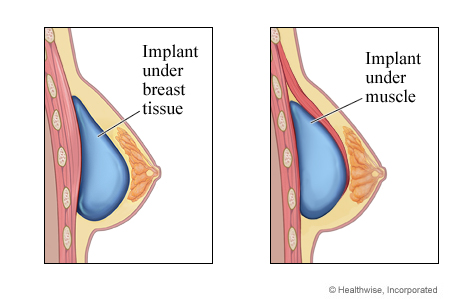 Breast Implants Under The Muscle