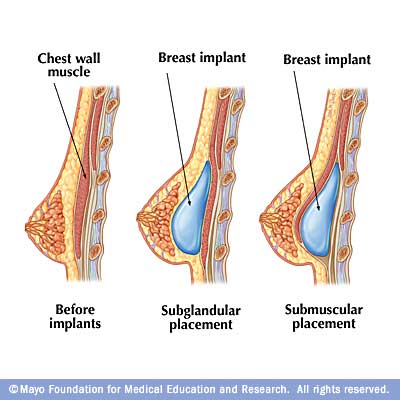 Breast Implants Under The Muscle