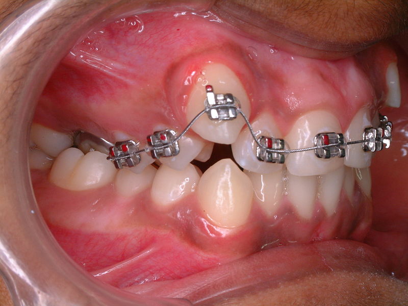 Ceramic Braces Cost In India