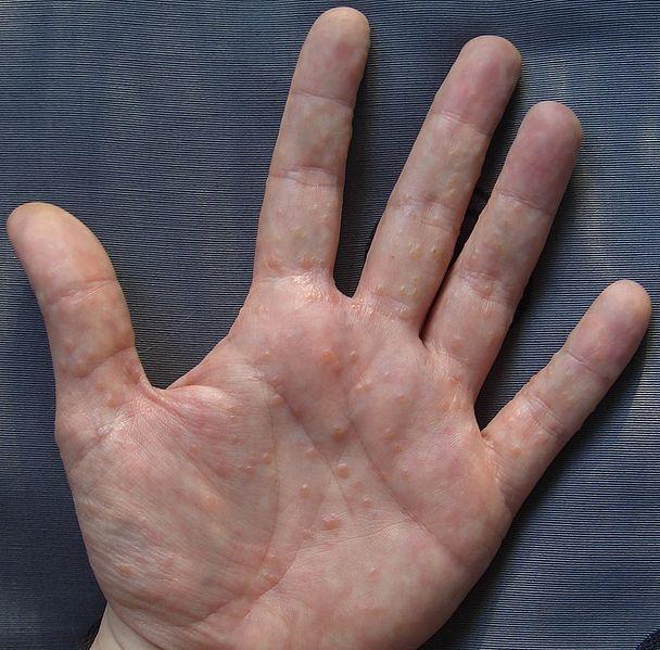 Contact Dermatitis Blisters Hands