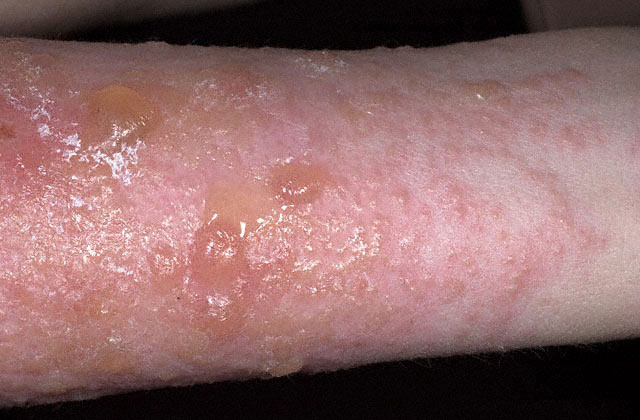 Contact Dermatitis Blisters Treatment