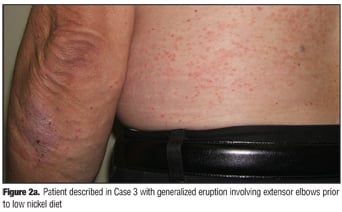 Contact Dermatitis Causes