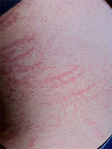 Contact Dermatitis Causes Symptoms