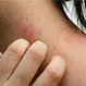 Contact Dermatitis Causes Symptoms