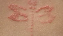 Contact Dermatitis Causes Symptoms