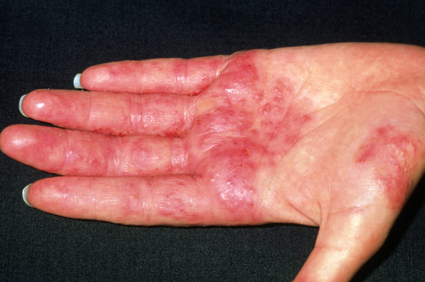 Contact Dermatitis Causes Treatment